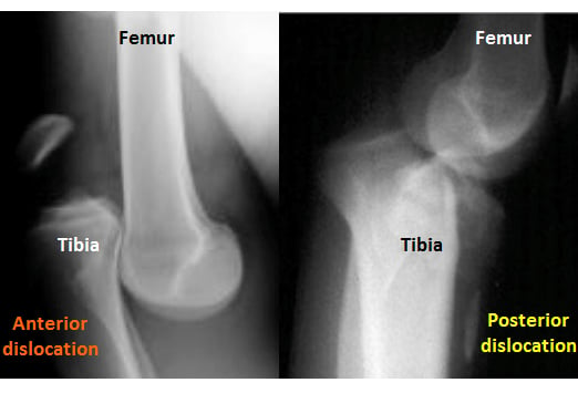 knee dislocation 1